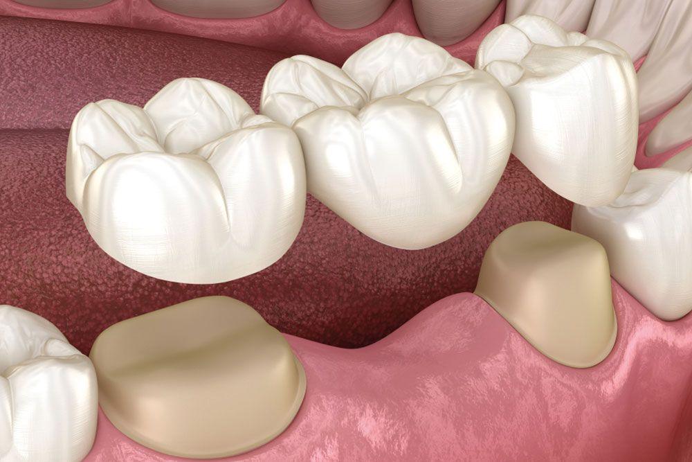 Education 28 Dental Bridges 1260385081.jpg.optimal