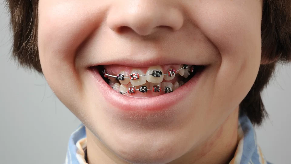 Braces For Kids 26 3 2