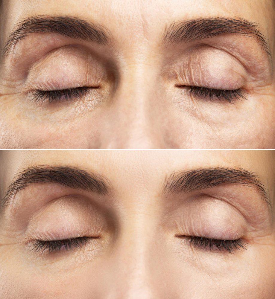 Dark eye circles / under eye rejuvenation with PRP/PRF 4 15495