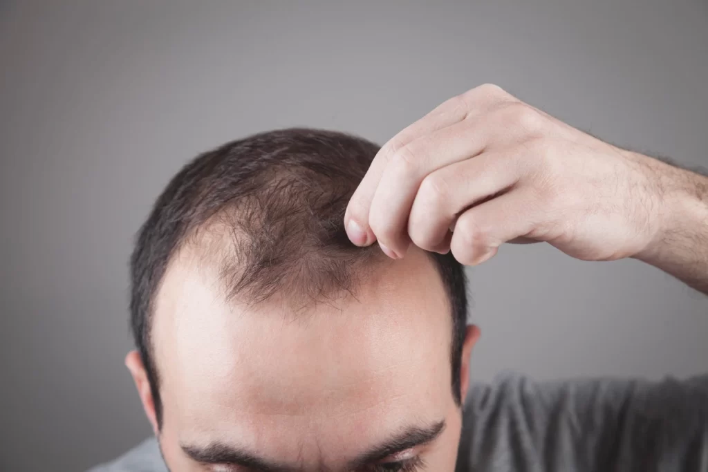 Special Offers 22 Hair Loss Treatment