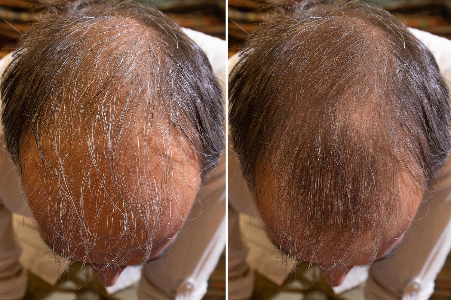 PRP & PRF Hair loss treatments 5 1606