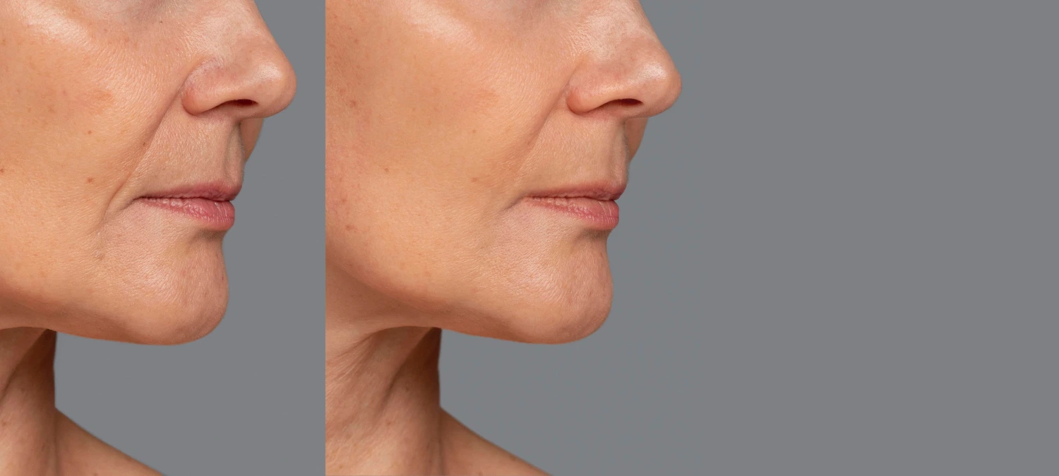 Skin Rejuvenation / Vampire Face with PRP/PRF 4 2149123615