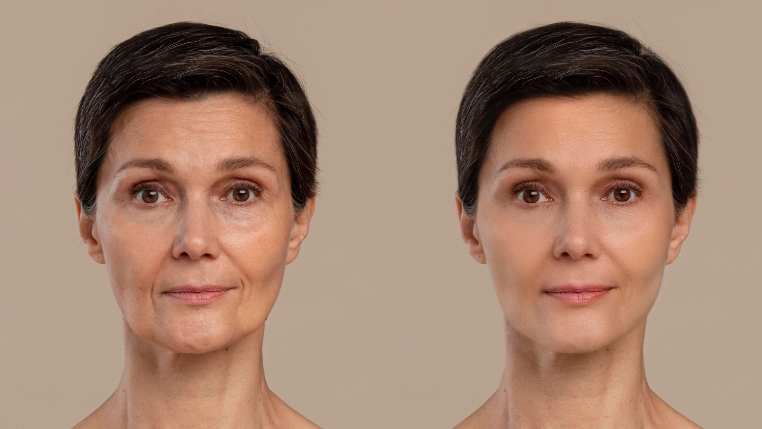 Skin Rejuvenation / Vampire Face with PRP/PRF 3 2149123619