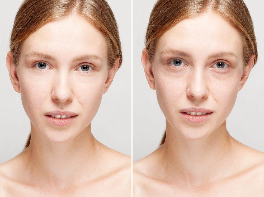 Dark eye circles / under eye rejuvenation with PRP/PRF 7 3834