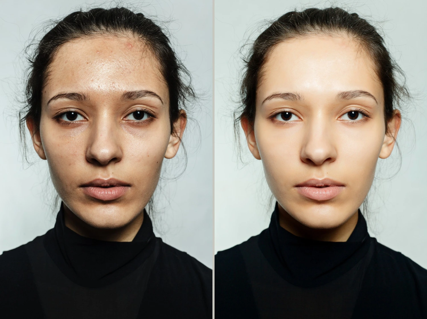 Skin Rejuvenation / Vampire Face with PRP/PRF 5 4830