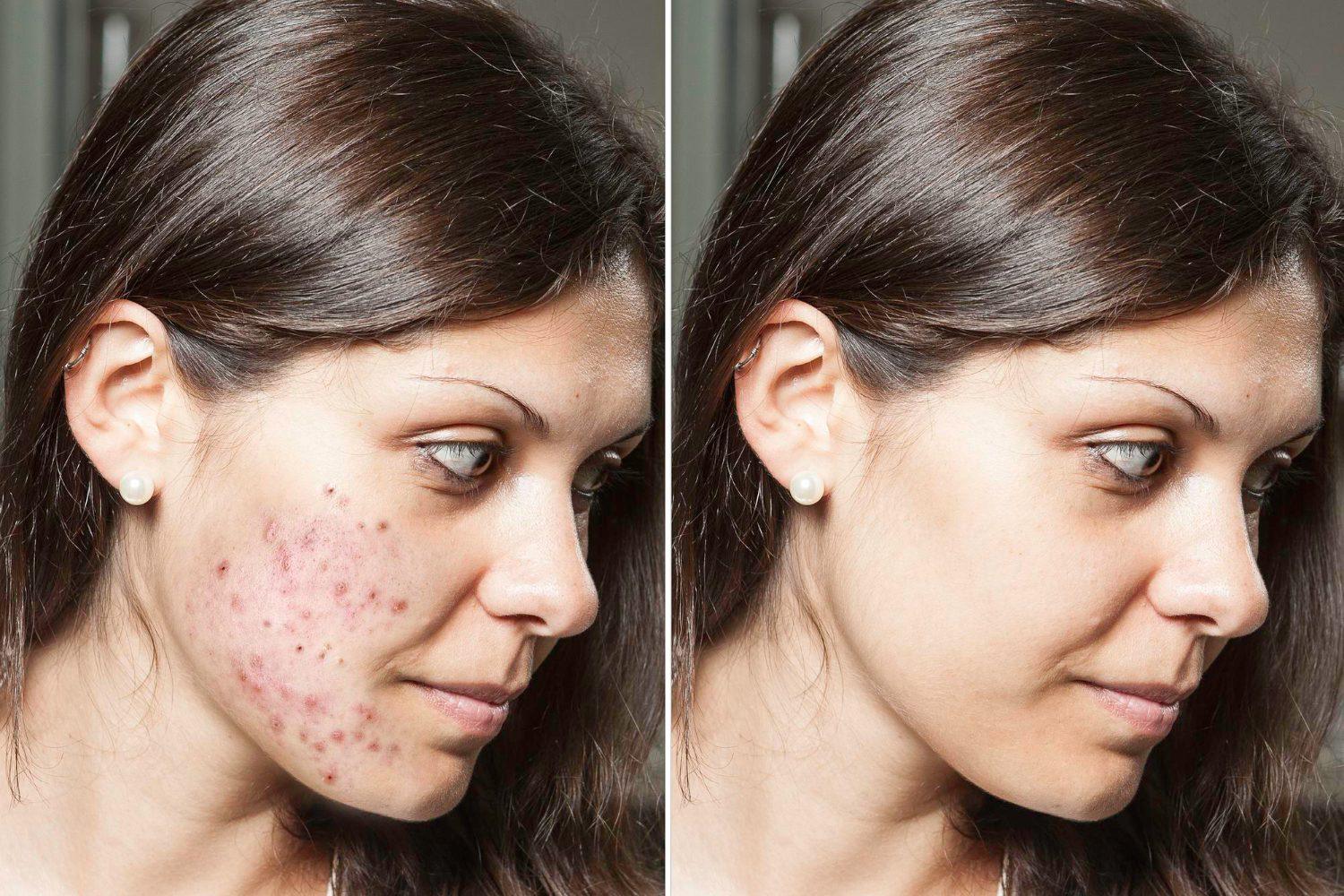 Acne and acne scars treatment with PRP/PRF 5 824