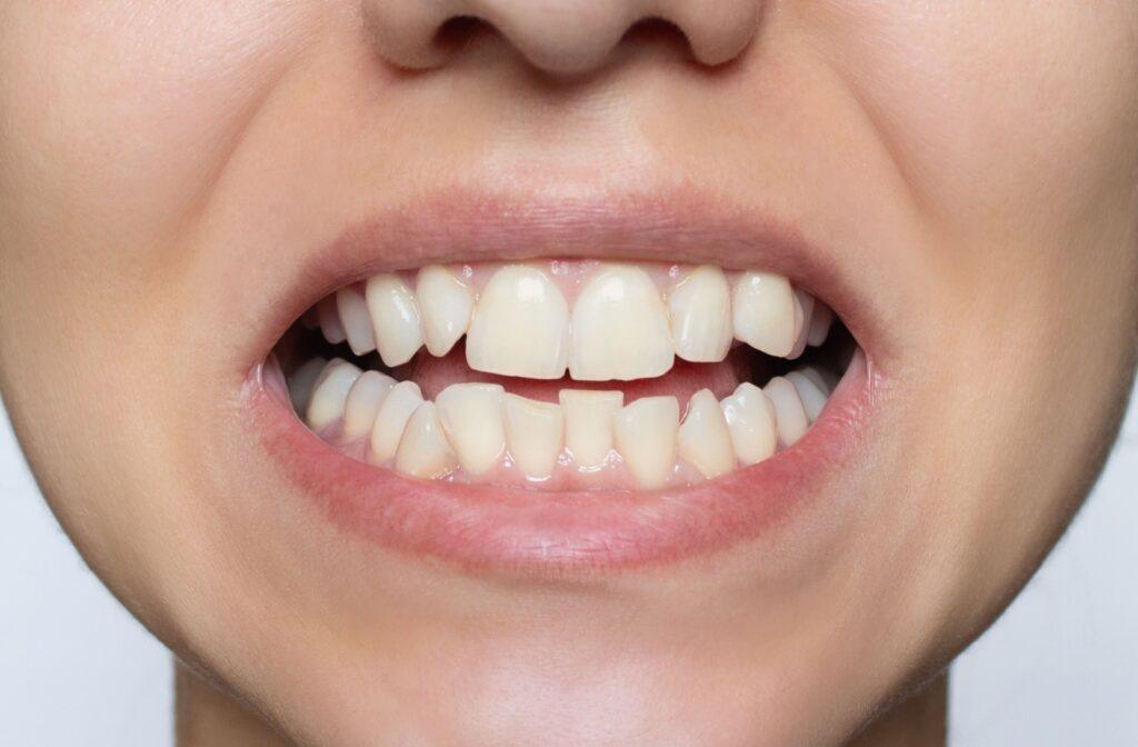 The Best Way to Fix Crooked Teeth The Best Way to Fix Crooked Teeth