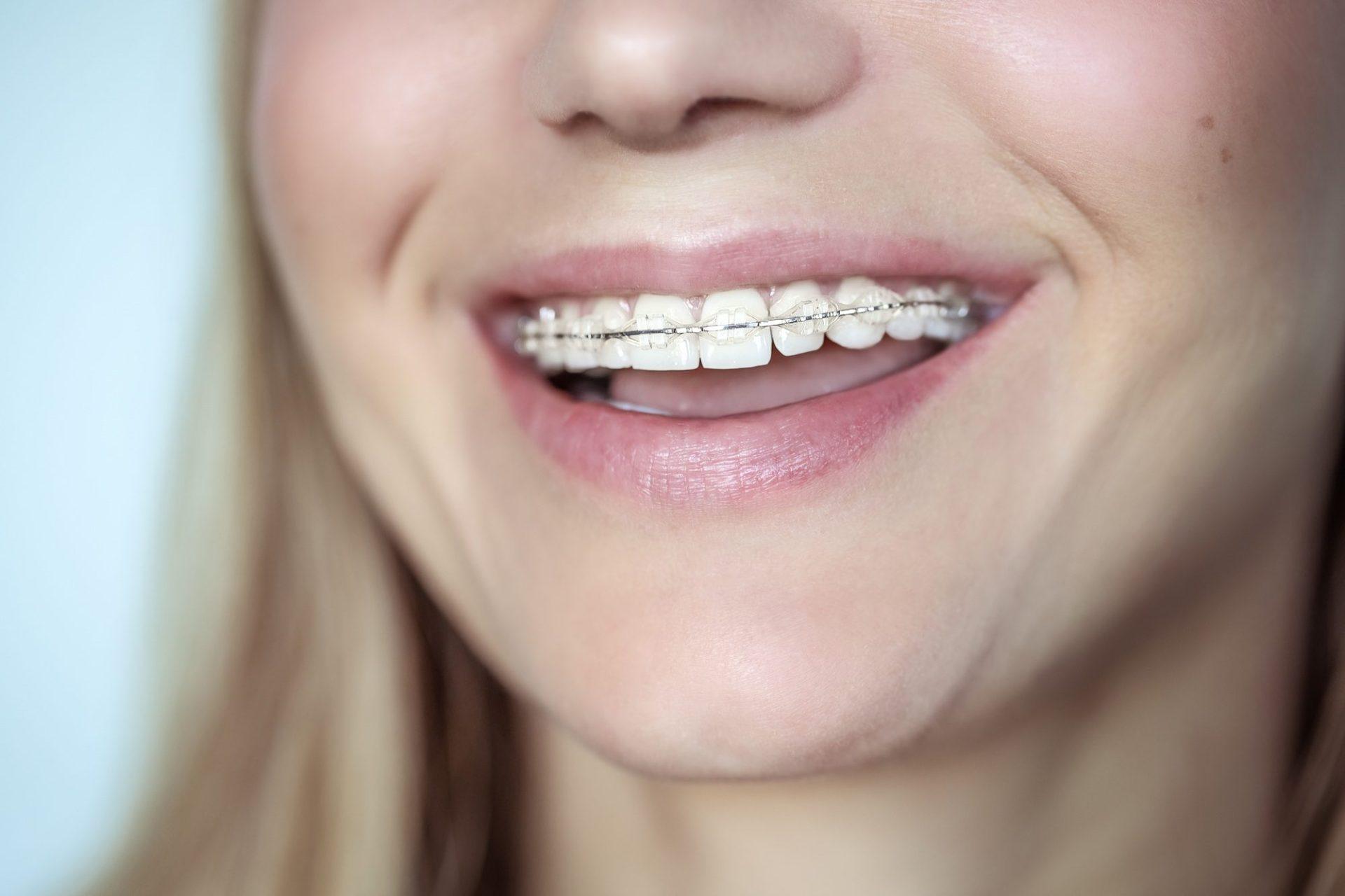 Ceramic Braces 29 braces treatment for a crooked teeth