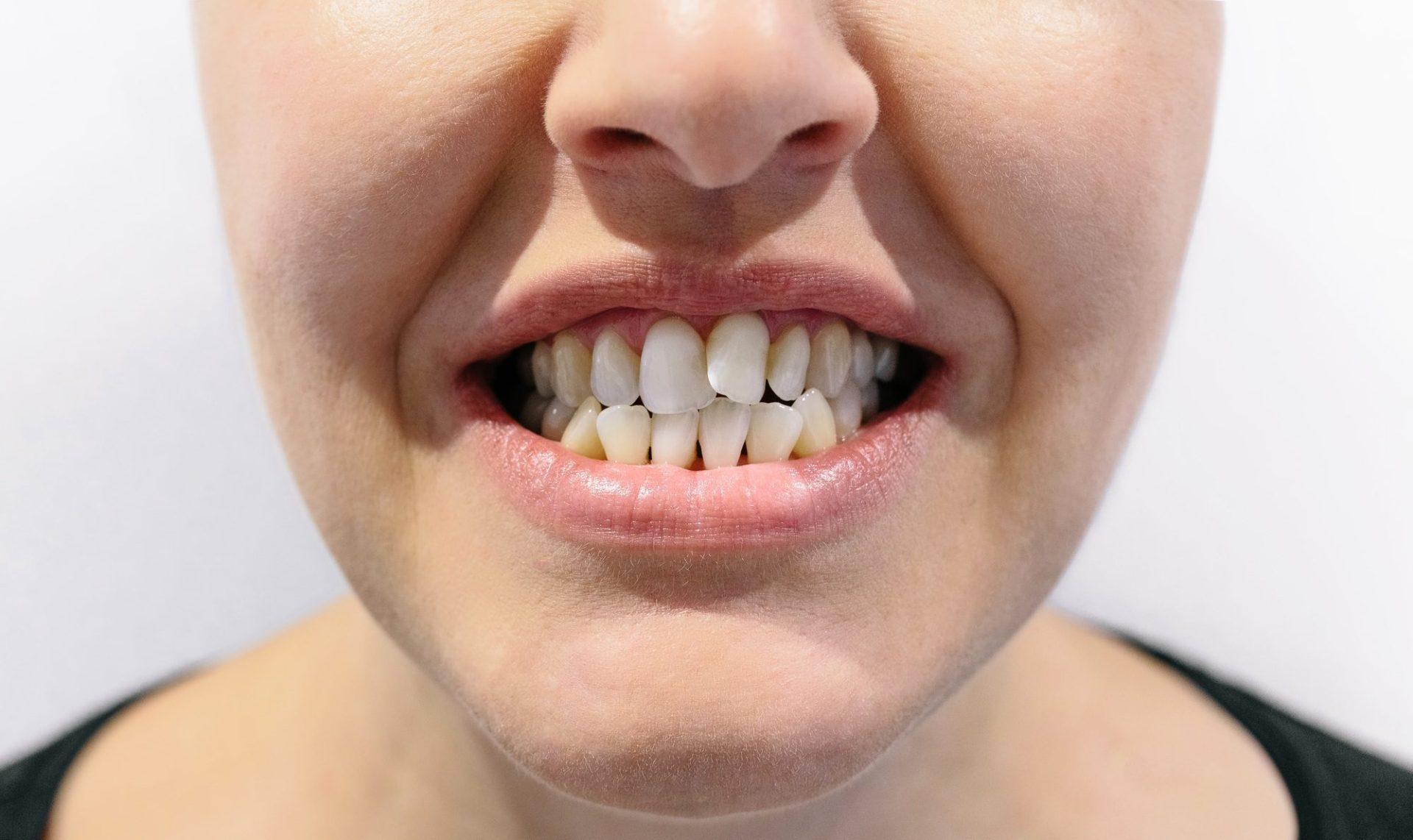 Ceramic Braces 27 woman mouth with dental crowding