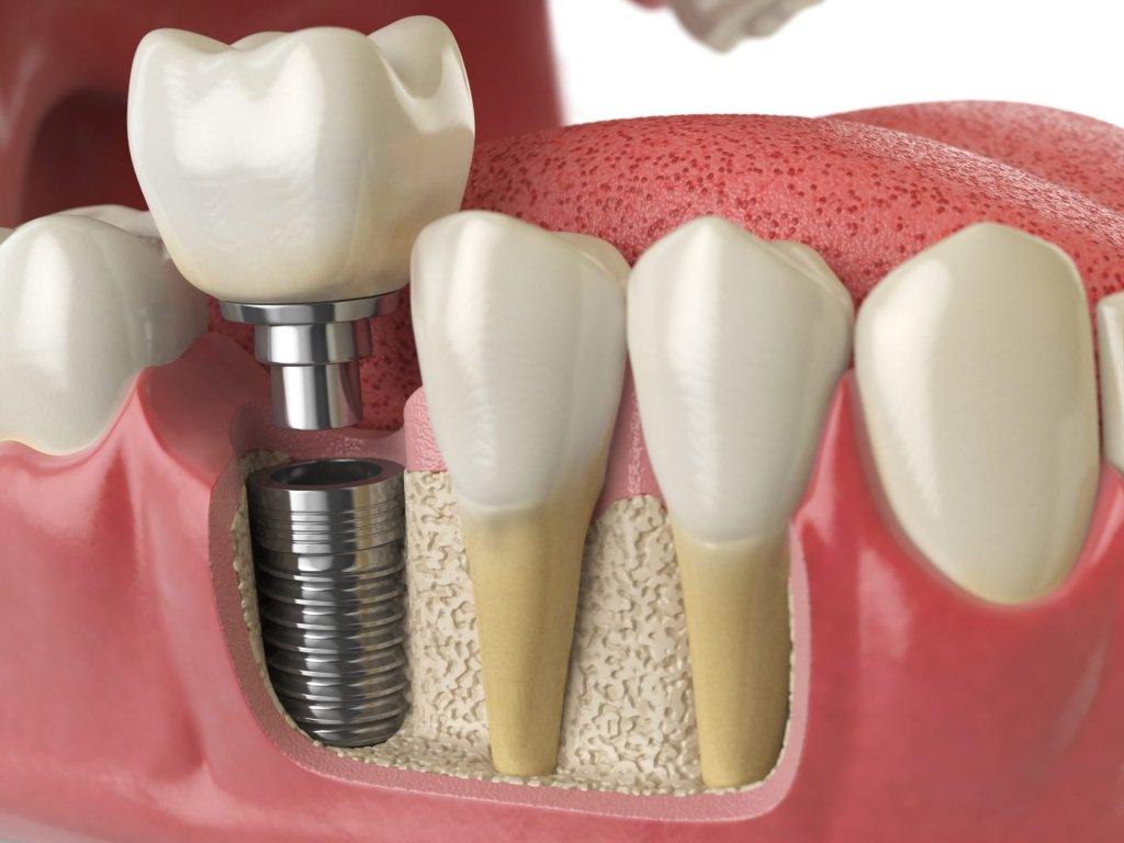 Dental Implants Sydney : Restore Your Smile Today! 7 anatomy of healthy teeth and tooth dental implant in human dentu