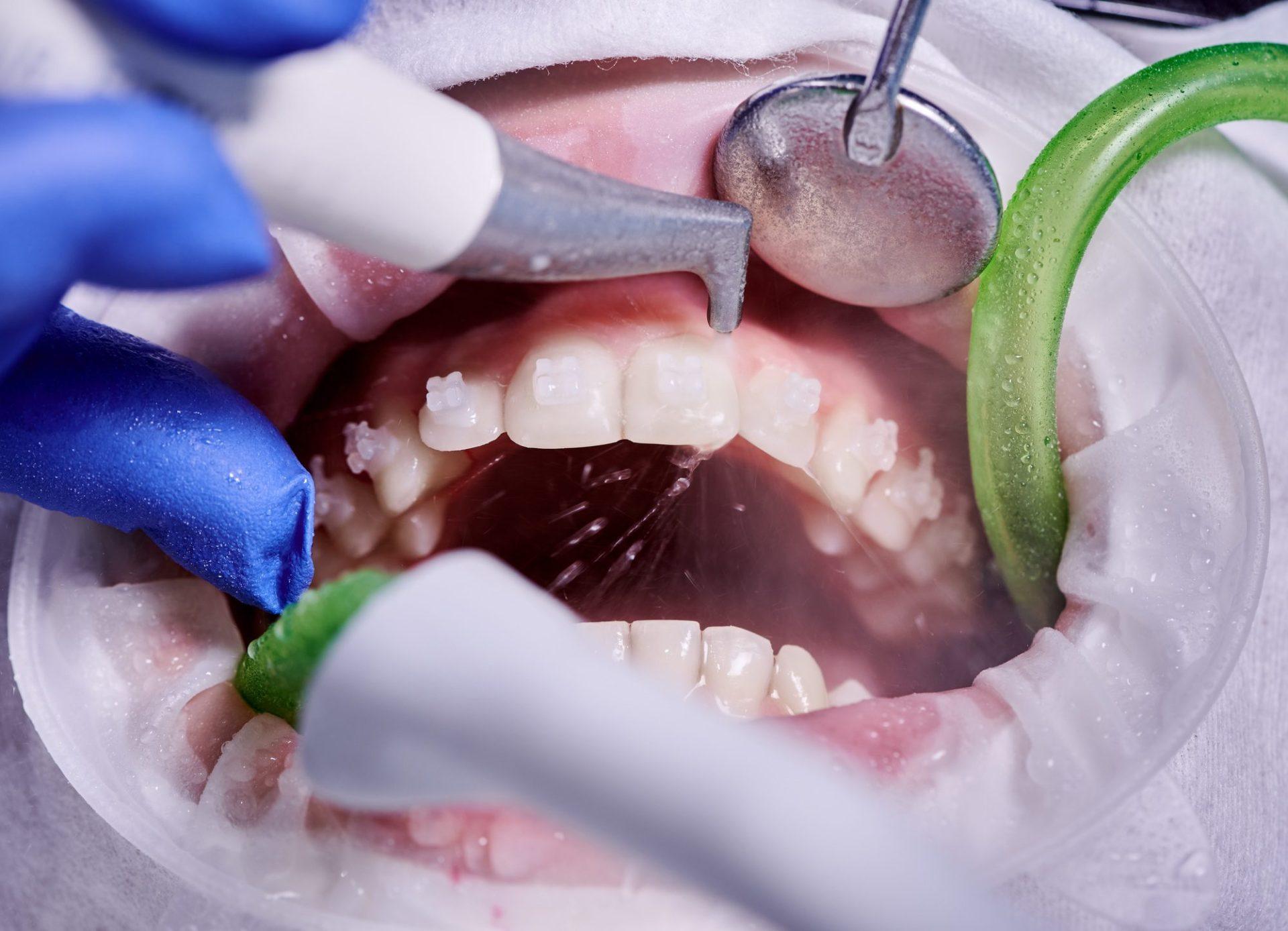 close up picture of a woman s mouth during dental procedure of cleaning teeth close up picture of a woman s mouth during dental procedure of cleaning teeth
