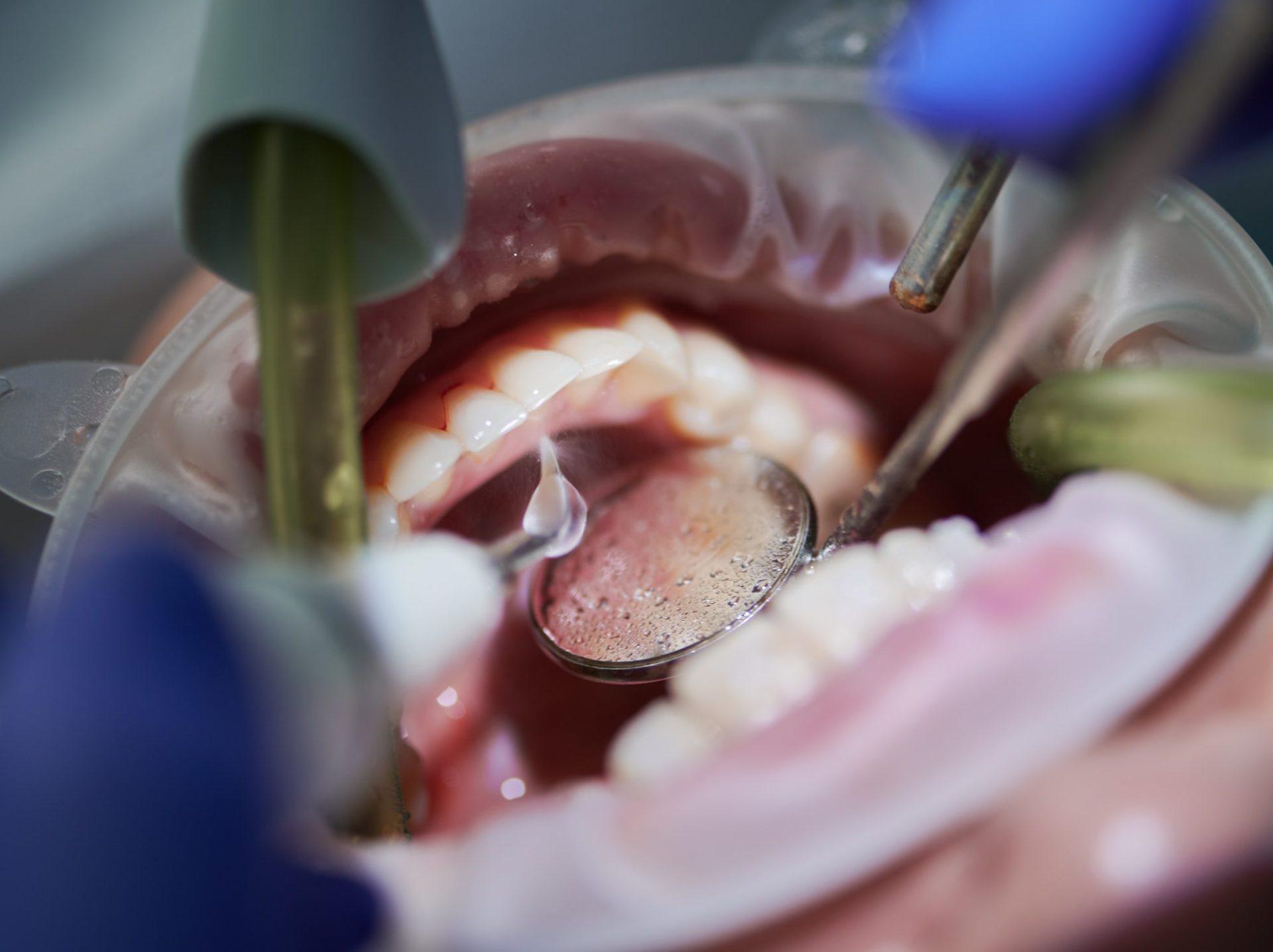 orthodontist doing professional teeth cleaning in dental clinic orthodontist doing professional teeth cleaning in dental clinic