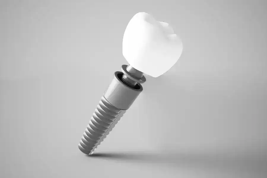 Benefits of Single Tooth Implant Treatment