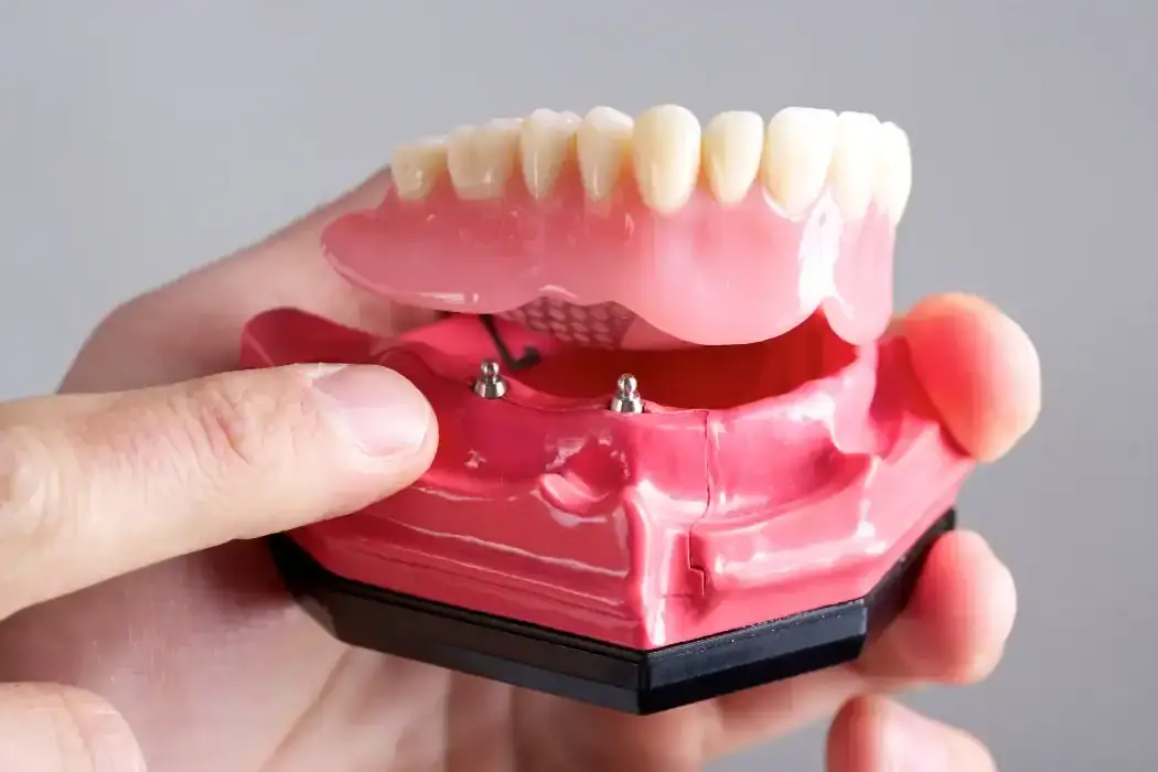 Cost of Full Mouth Implants in West Ryde