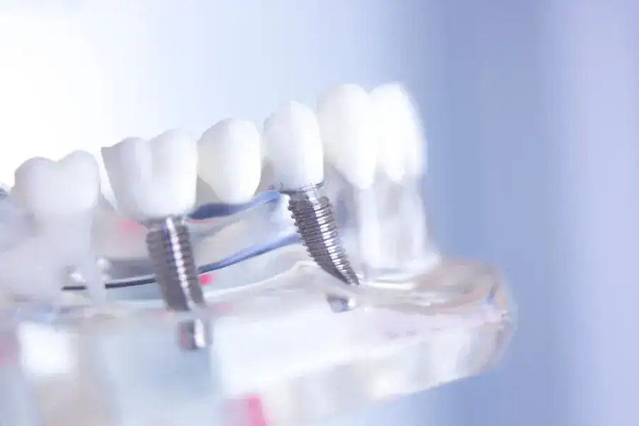 Teeth Implants 30 Our Step-by-Step Dental Implant Process
