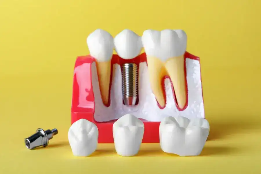 Signs You May Need Single Tooth Dental Implant