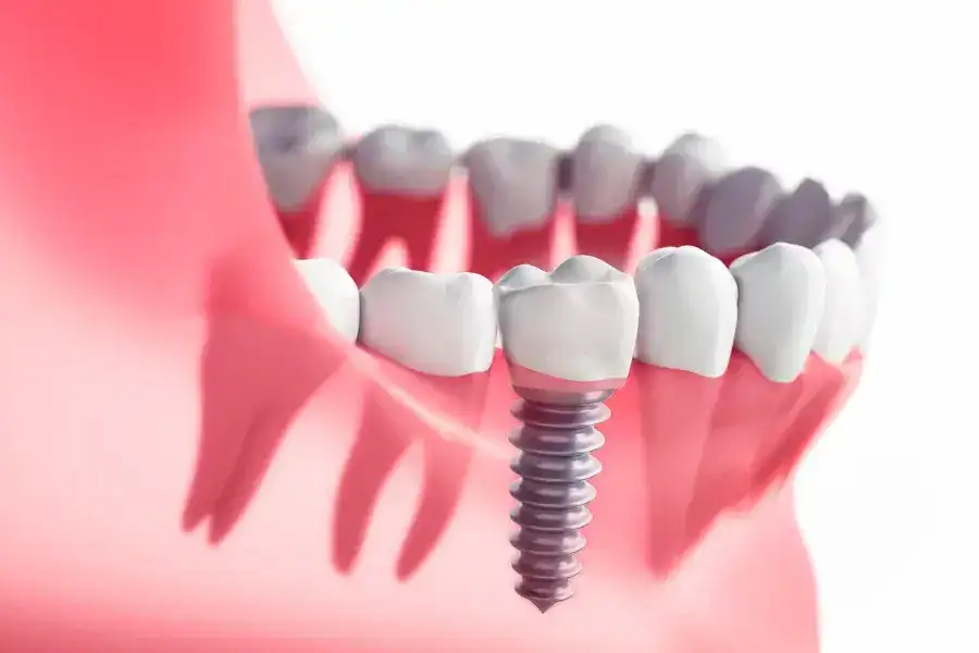 Education 25 Single Tooth Implants