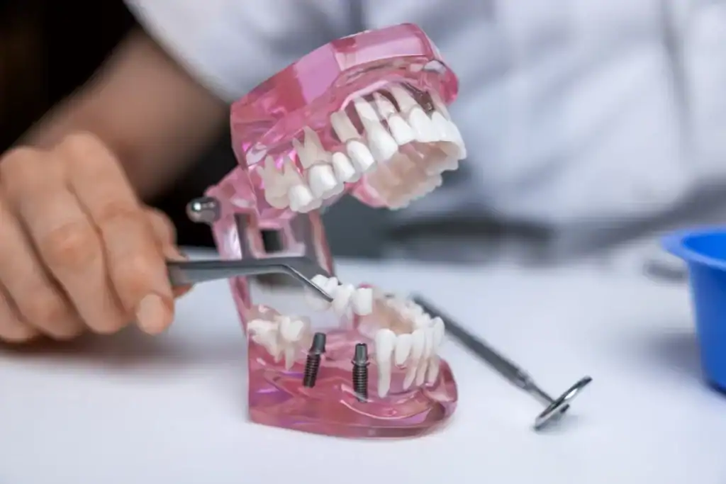 What Are Full Mouth Implants