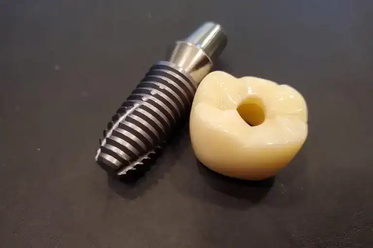 What Is a Single Tooth Implant