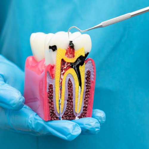 Root Canal Treatment 13 Root Canal Treatment