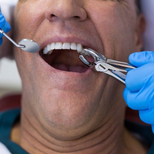 Teeth Extractions 14 Teeth Extractions