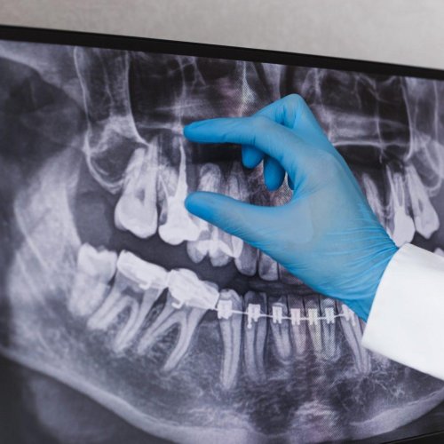 Root Canal Treatment 14 Root Canal Treatment