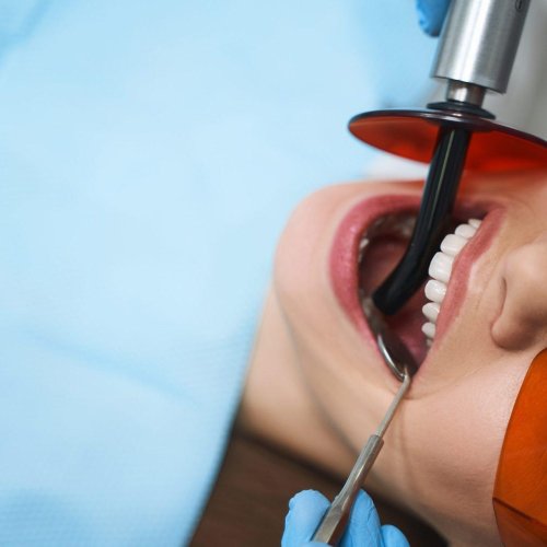 Root Canal Treatment 15 woman is getting root canal stock photo