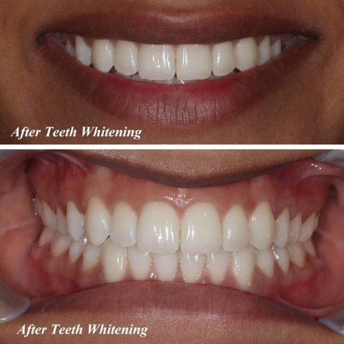 Teeth Whitening