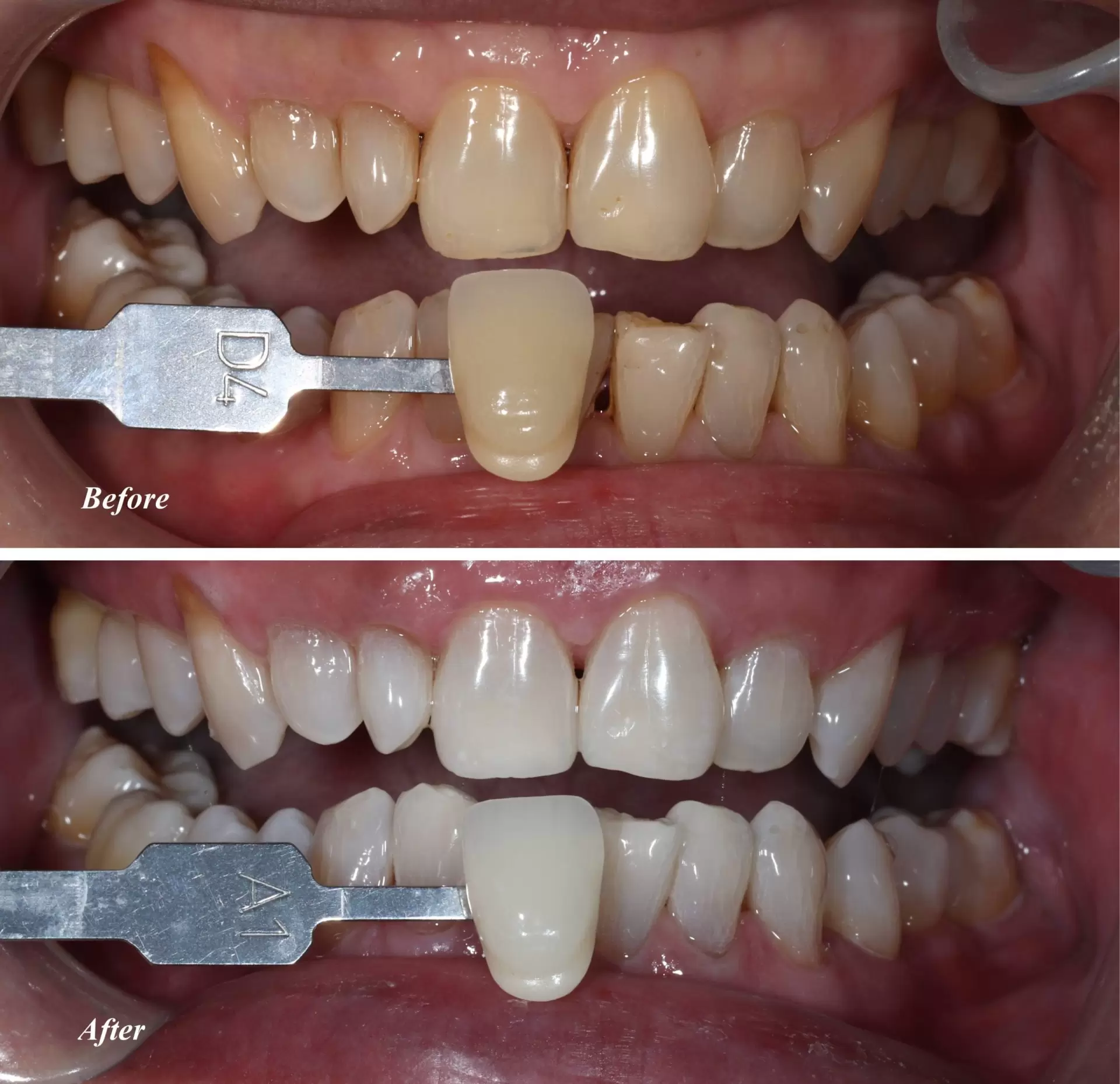 Teeth Whitening