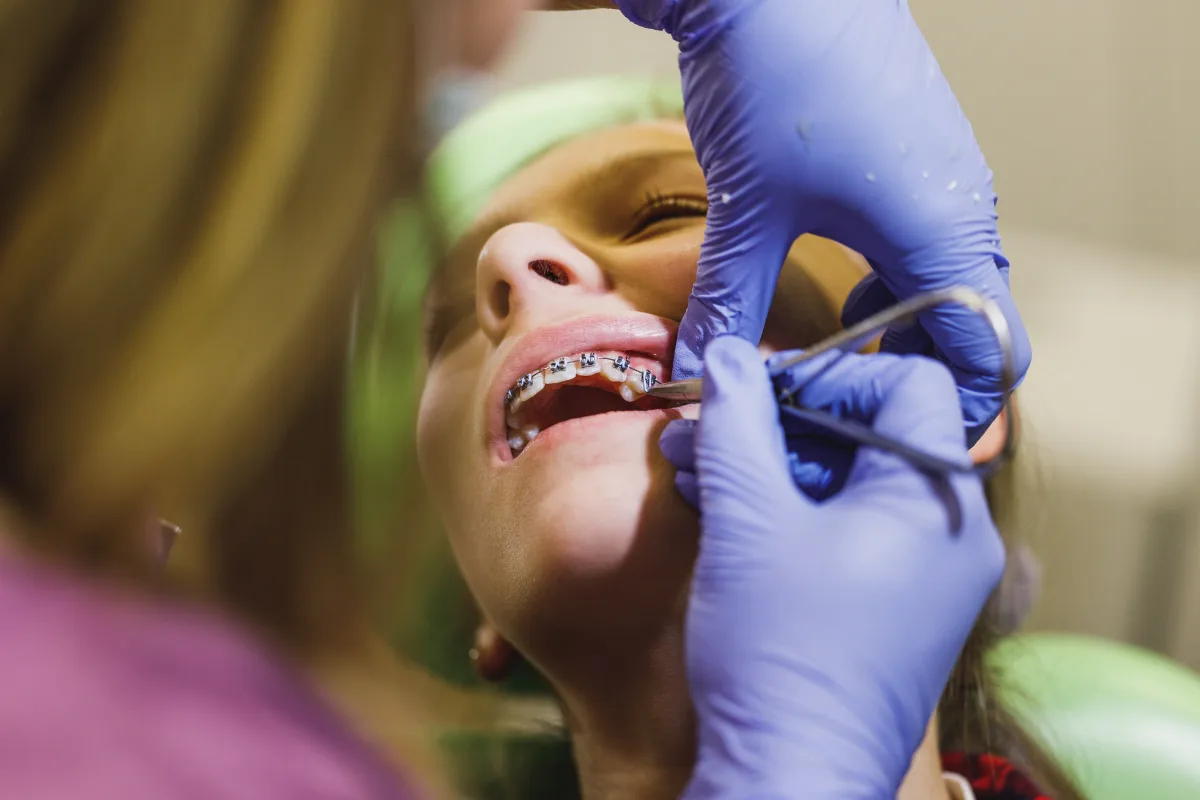 Metal Braces 29 Orthodontics
