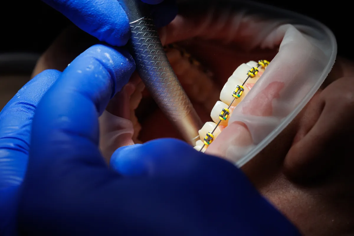 Orthodontics 14 Orthodontics
