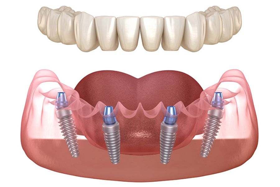 All-on-4® Dental Implants 27 All-on-4® Dental Implants
