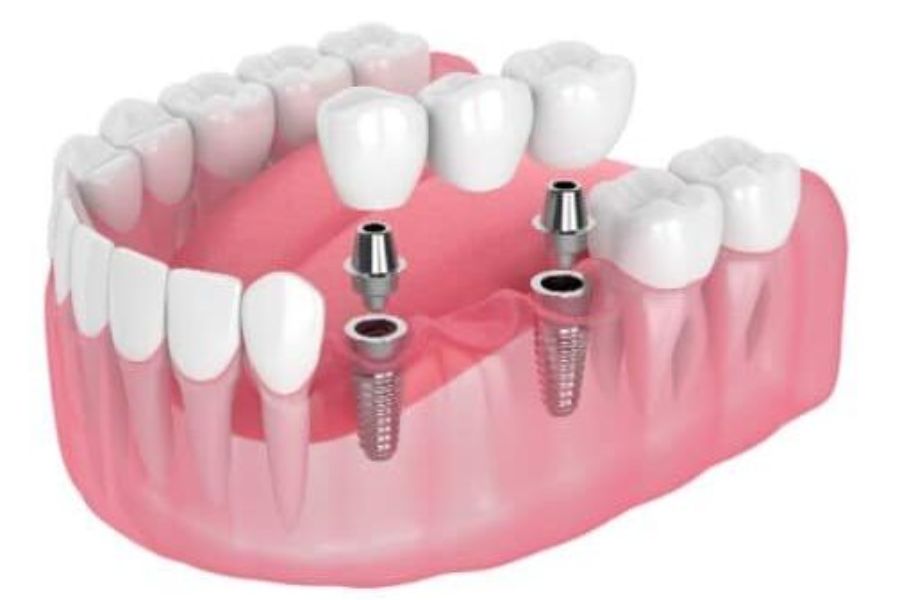 Teeth Implants 28 Multiple Teeth Implants