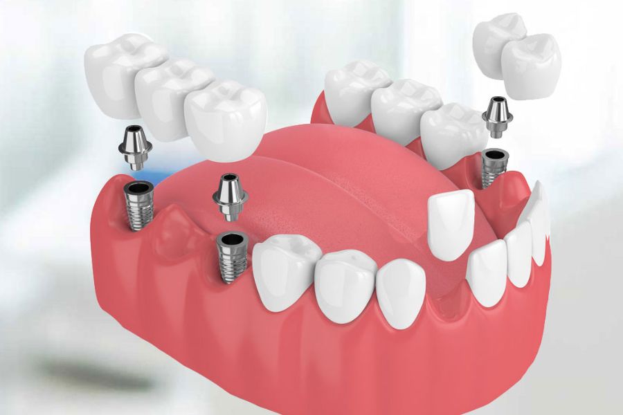 Teeth Implants 29 Multiple Teeth Implants