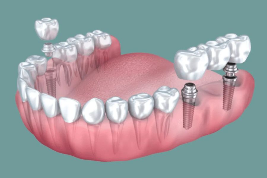 Teeth Implants 27 Multiple Teeth Implants
