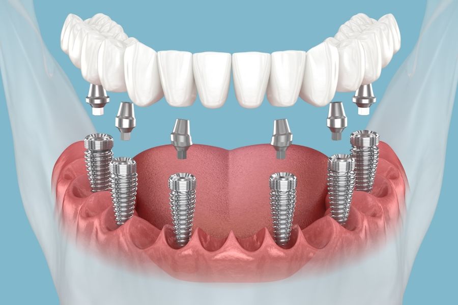 All on 6 Dental Implants
