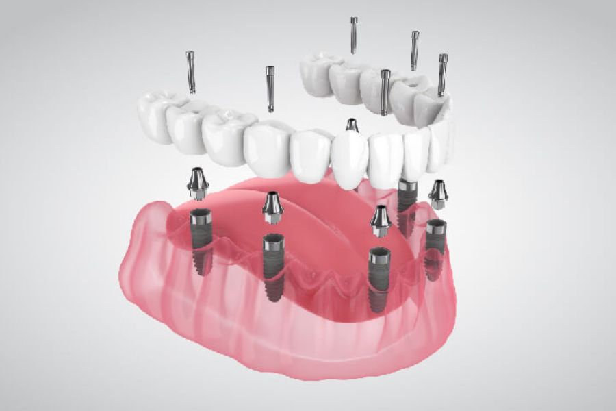 All on 6 Dental Implants