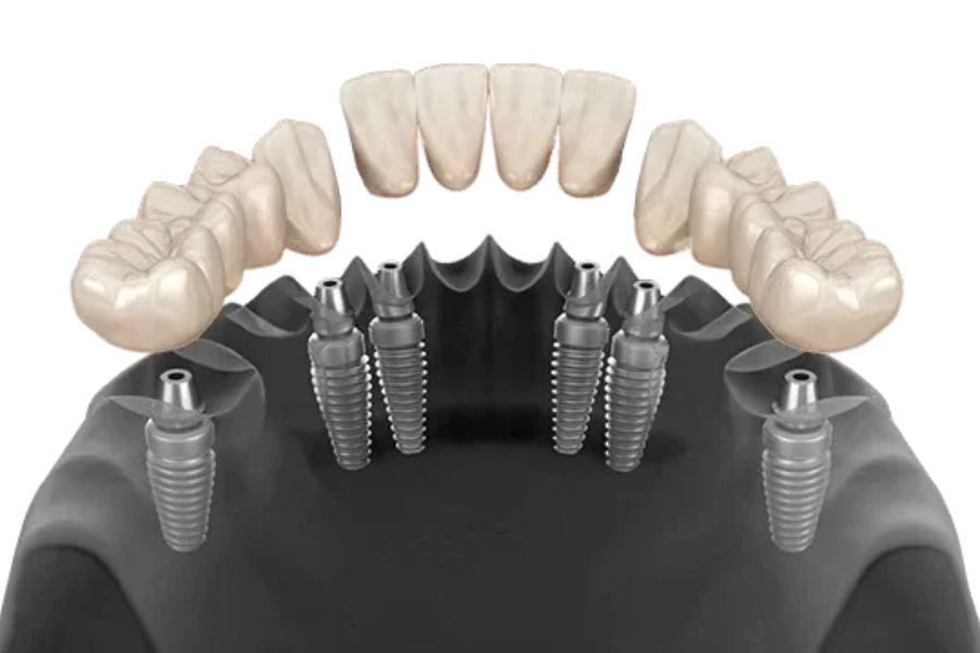 All on 6 Dental Implants