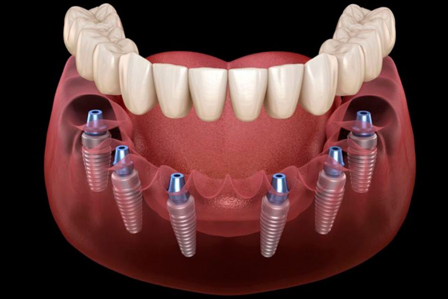 All on 6 Dental Implants