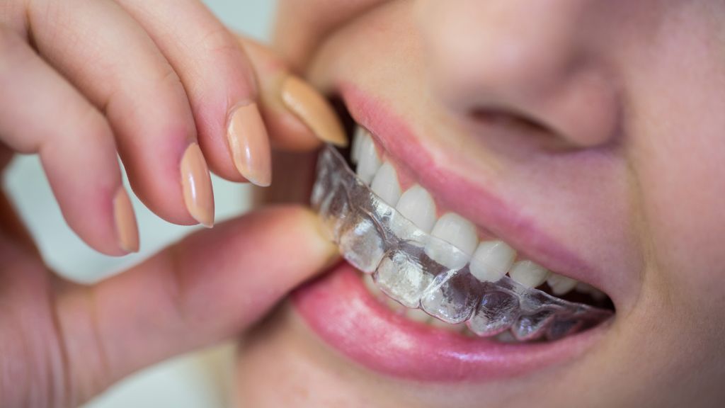 Special Offers New 2 12 What Happens in a Clear Aligner Consultation