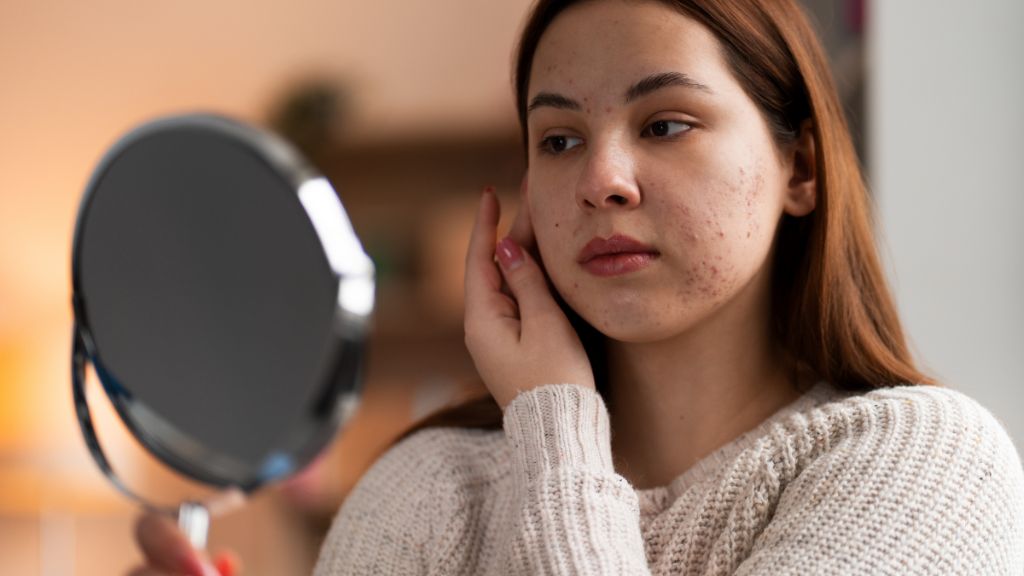 Why Do Some Acne Scars Need Professional Care? 1 Why Do Some Acne Scars Need Professional Care