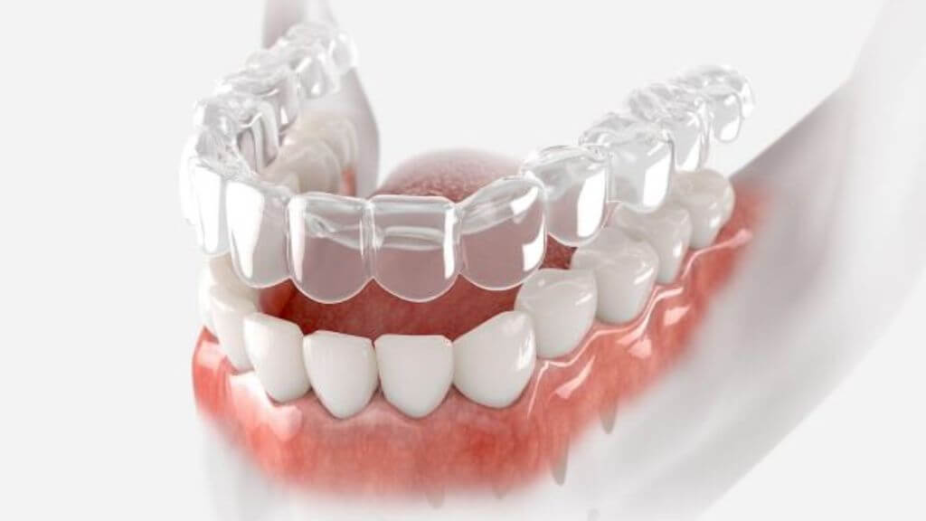 Education 31 Clear Aligners