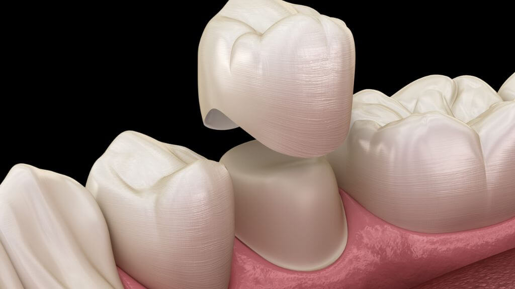 Education 29 Dental Crown - Education