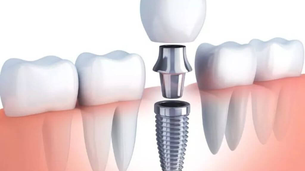 Education 32 Dental Implant -