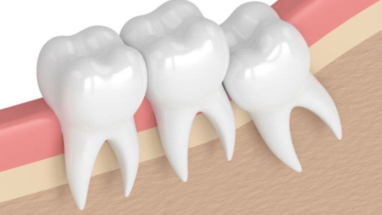 Teeth Extraction