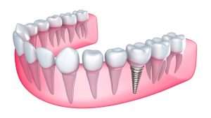 Single Implant