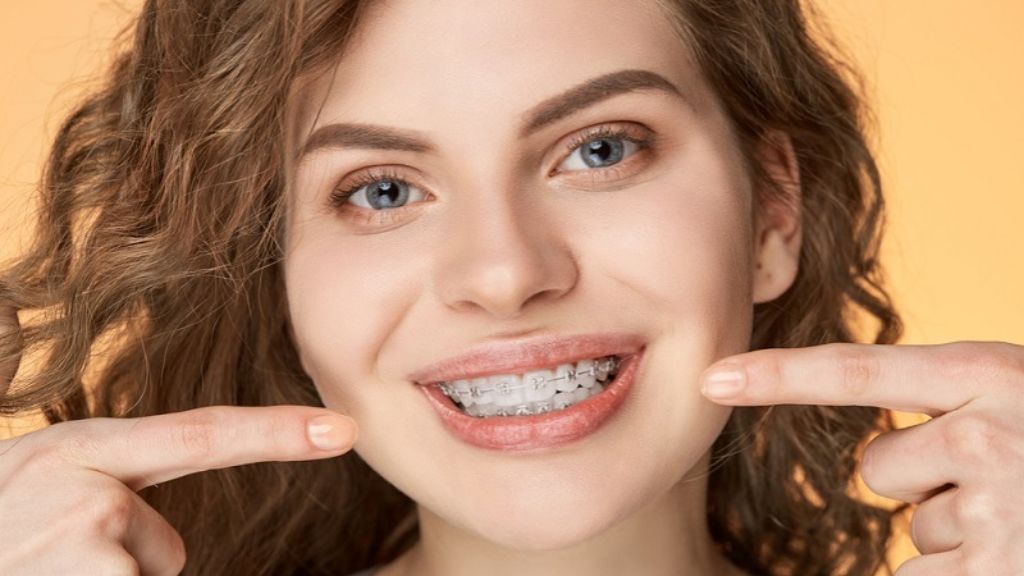 What Happens During Ceramic Braces Placement? 4 Ceramic Braces