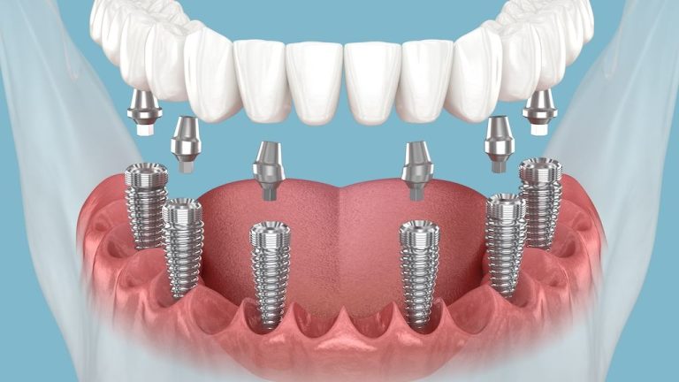 All-on 6 Dental Implants