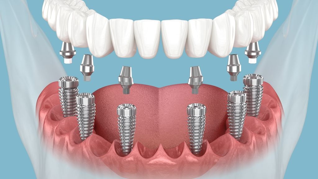 All-on 6 Dental Implants