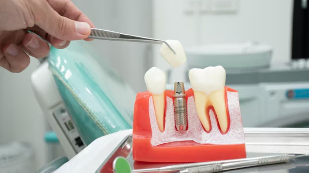 How Much Are Dental Implants Cost With Specialist Involvement? 15 Dental Implants